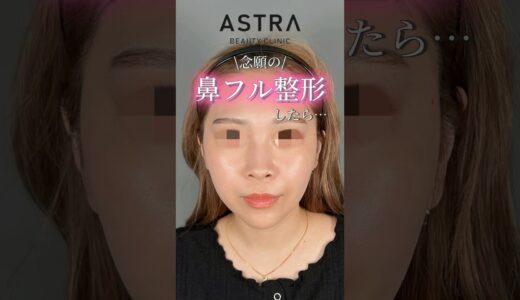 鼻フル整形すると…？🩵✨#astrabeautyclinic #アストラビューティクリニック #美容整形 #鼻整形 #忘れ鼻 #鼻整形ダウンタイム