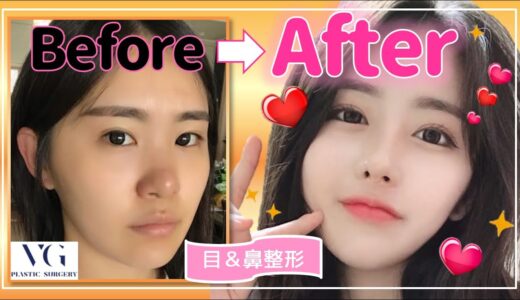 【大公開】韓国整形（目＆鼻整形）★劇的ビフォーアフター【美容整形/before＆after】