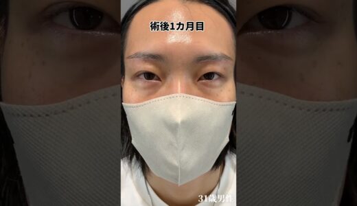 眉下リフトはナチュラルに変化できるから、男性にもおすすめ👀 #目元整形 #眉下切開 #眉下リフト #美容整形