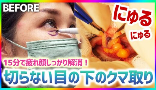 【30代必見】疲れ目解消！切らない目の下のクマ取り施術徹底解説！【クマ取り整形/脂肪取り/目の下のふくらみ/目の下のたるみ】