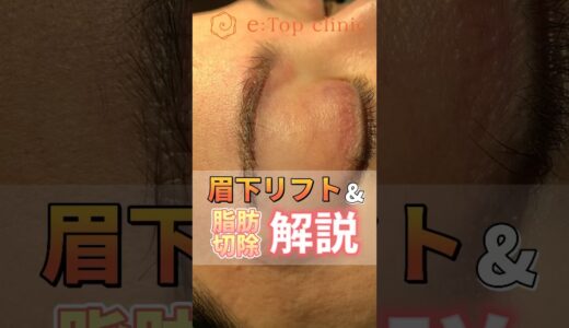 隠れた二重が出現？！#美容整形 #眉下切開 #眉下リフト