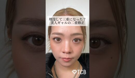 【二重整形】埋没して三重になった？美人ギャルの二重修正 #shorts