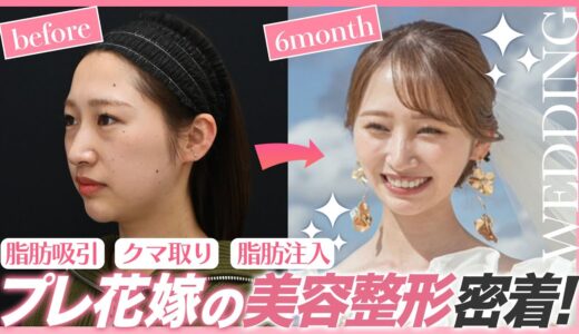 【花嫁美容】半年後の結婚式に向けて人生初整形！ブライダルエステ不要「どの角度から見ても綺麗と言われたい♡」一生に一度の大切な日まで密着【クマ取り＋脂肪吸引＋脂肪注入】