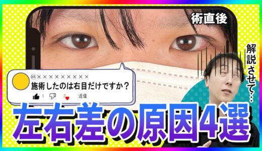 【これって失敗？】二重整形の左右差が起きる原因を美容外科医が解説します！