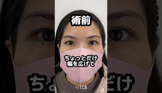 【二重整形】プチ整形！？　#二重整形 #二重埋没 #tcb #shorts