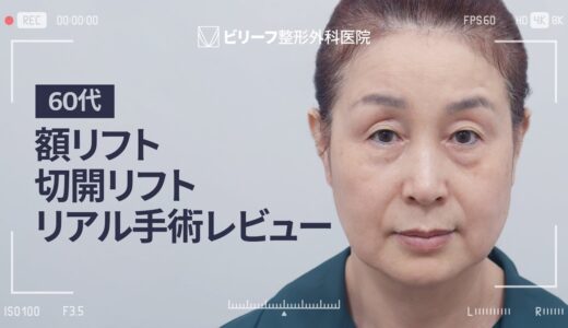 60代の人性初美容整形！リアルレポ第一弾！【切開リフト、額リフト、眉下切開、下眼瞼】