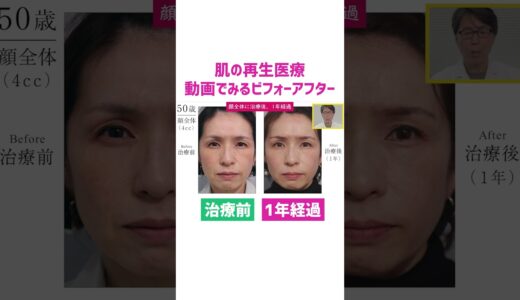 美容治療を受けた症例の解説｜50代からはじめるエイジングケア治療「肌の再生医療」