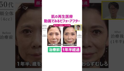 美容治療を受けた症例の解説｜50代からはじめるエイジングケア治療「肌の再生医療」