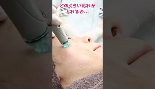 【毛穴洗浄】美容皮膚科で顔の汚れがどれだけとれるか。。。