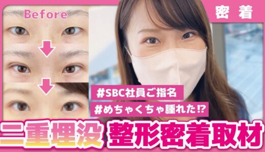 【整形密着】めちゃくちゃ腫れた！？ 埋没二重手術～ダウンタイムまで完全公開！【湘南美容クリニック】