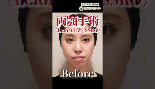 【壮絶】骨切り山ちゃんの骨切りbefore/after #整形 #骨切り #お金持ちの息子の親父 #麻生泰 #東京美容外科 #豊胸 #Shorts