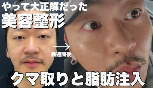 【美容整形】クマ取りして1ヶ月密着したら顔面人生変わった【クマ取り・脂肪注入・ダウンタイム】