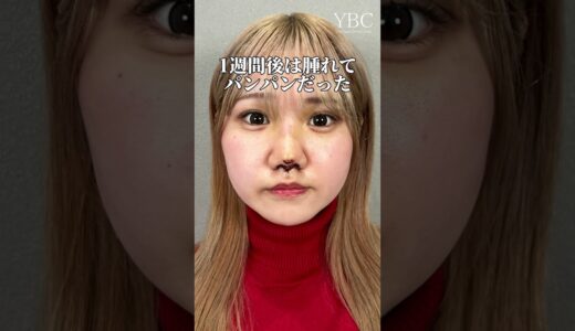 【鼻整形】【人中短縮】鼻整形して人中も短くしたら…#shorts