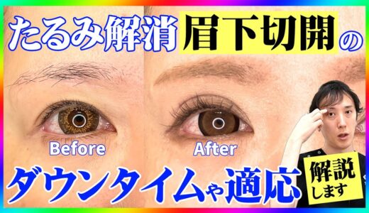 【まぶたのたるみ解消】眉下切開のダウンタイムと傷跡は？症例や適応な方も解説！