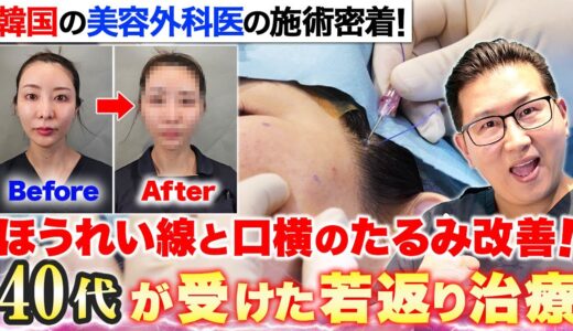 【40代必見】ほうれい線・口横のたるみ・ニキビ跡を改善した施術の様子をお見せします！