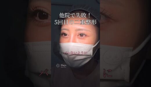 【二重整形】5回目の二重整形！#shorts