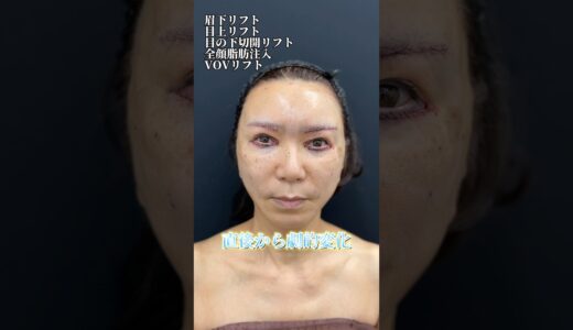 地方在住60歳女性がジェントル先生の全顔若返り整形を受けました☆ #眉下切開 #目上切開 #脂肪注入