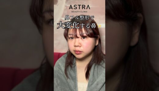 鼻フル整形で大変身☺️✨#astrabeautyclinic  #アストラビューティークリニック #塩満恵子 #鼻整形 #美容整形 #忘れ鼻#鼻尖形成 #隆鼻術 #耳介軟骨移植 #小鼻縮小#鼻中隔延長