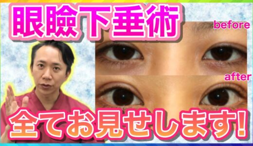 二重　ダウンタイム　下垂　変化　★☆美容整形・眼瞼下垂・目整形☆★