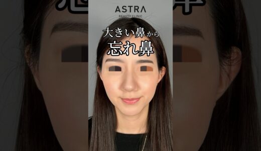 存在感のある鼻を忘れ鼻に👃✨.#astrabeautyclinic  #アストラビューティークリニック #塩満恵子 #鼻整形 #美容整形 #忘れ鼻 #似合わせ鼻 #骨格似合わせ鼻