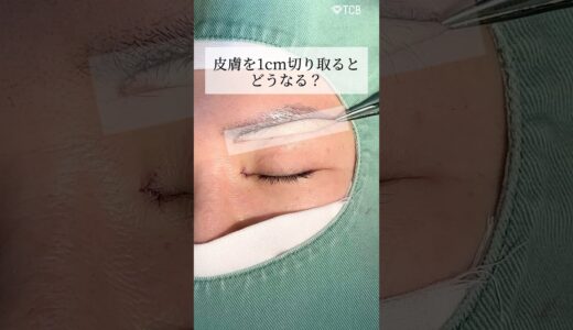 【眉下リフト＋目頭切開】眉毛の皮膚を1cm切り取った結果… #shorts