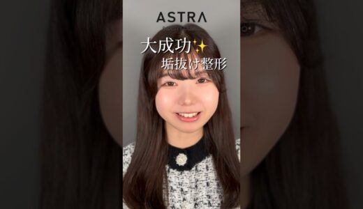 大成功垢抜け整形✨.#astrabeautyclinic  #アストラビューティークリニック #塩満恵子 #鼻整形 #美容整形 #忘れ鼻 #似合わせ鼻 #骨格似合わせ鼻