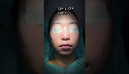 人生変わる、美容整形。#shorts #鼻整形 #美容整形 #rhinoplasty #脂肪注入