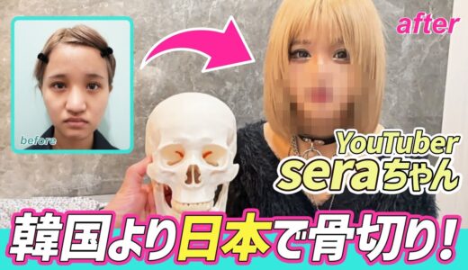 YouTuberのseraちゃん！韓国より日本で骨切り！鼻整形に密着！