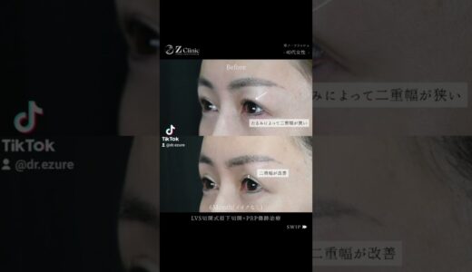 40代女性・LVS切開式眉下切開・PRP傷跡治療