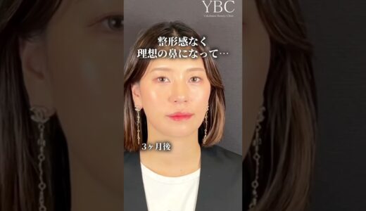 【鼻整形】30代の美人さんが鼻整形したらどうなる？#shorts