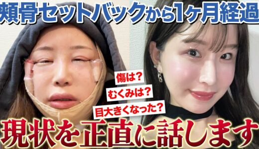 頬骨セットバックから1ヶ月が経過しました！【美容整形】