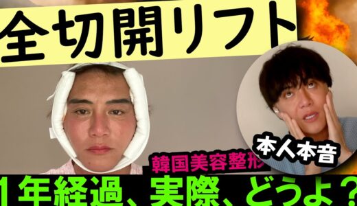 【全切開リフト体験談】韓国での美容整形を振り返る｜美肌マッスル社長の挑戦