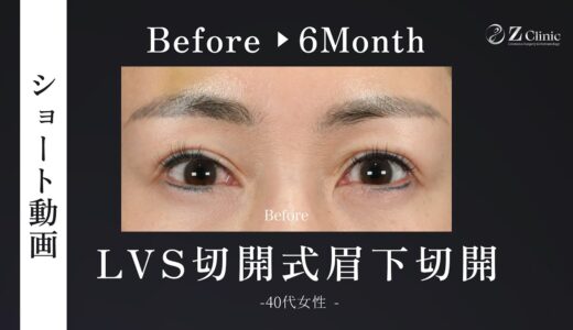 40代女性のまぶたのたるみ取り：LVS切開式 眉下切開＋PRP傷跡治療