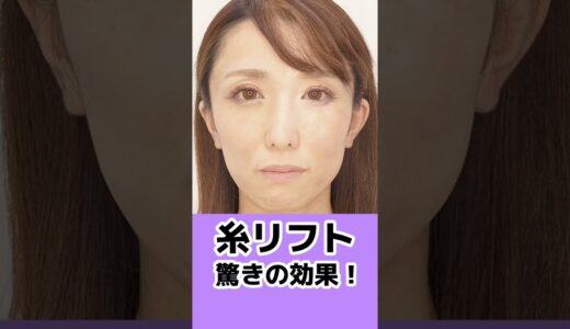 【糸リフト】待ちに待った美容整形で驚きのアンチエイジング✨#shorts