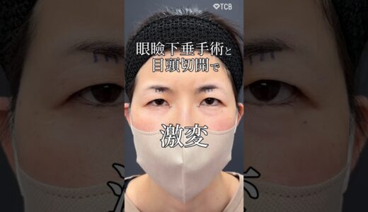 【二重整形＋目頭切開】20歳若返る眼瞼下垂手術 #shorts