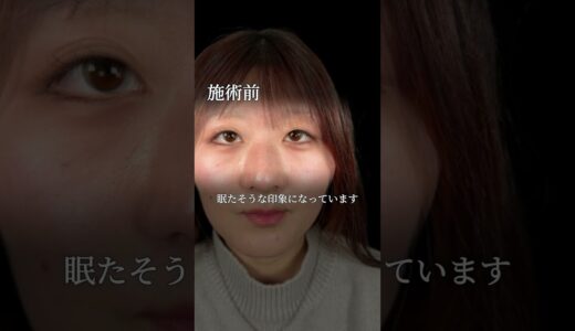 【まぶたの脂肪取り】重いまぶたを改善！#美容外科 #美容整形 #美容クリニック #美容 #整形