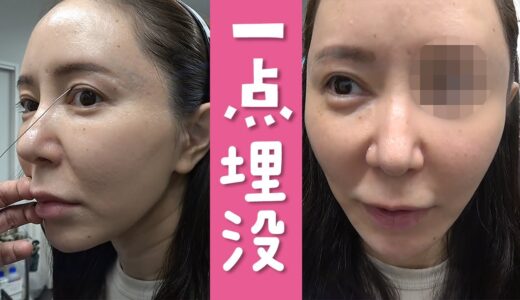 【美容整形】違和感があると言われ続けた左目とおさらば