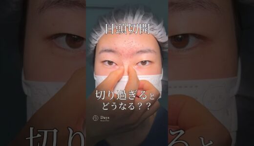 【二重整形/目頭切開】ご希望に合わせて施術いたします！#shorts