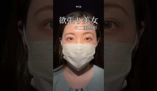 【二重整形】欲張り美女の二重整形🤩！！#shorts