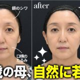 【51歳の若返り整形】加齢による頬のたるみ・額のシワが悩みのスタッフの母親、若返り手術に密着！1ヶ月後−5歳【自然な若返り】