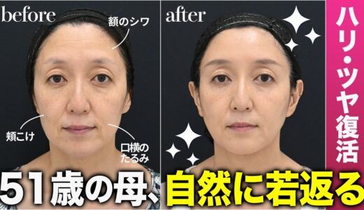 【51歳の若返り整形】加齢による頬のたるみ・額のシワが悩みのスタッフの母親、若返り手術に密着！1ヶ月後−5歳【自然な若返り】