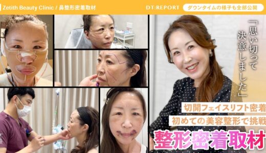 【切開フェイスリフト密着】人生初めての美容整形でフェイスリフトに挑戦【若返り / 王 蘇医師】壮絶なダウンタイムから三ヶ月…いったいどんな結果に…#若返り #ゼティス