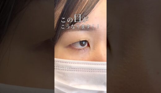 【二重整形/目頭切開】元の目元を活かした整形！#shorts