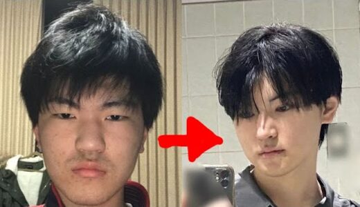 【美容整形】大学生男が韓国で顔全部改造してみた。【総額300万円】