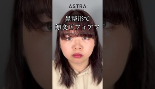 激変します‼️#astrabeautyclinic  #アストラビューティークリニック #塩満恵子 #鼻整形 #美容整形 #忘れ鼻 #似合わせ鼻 #鼻尖形成#耳介軟骨移植#鼻中隔延長#プロテーゼ