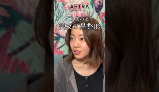 美女の鼻整形✨#astrabeautyclinic  #アストラビューティークリニック #塩満恵子 #鼻整形 #美容整形 #忘れ鼻 #似合わせ鼻 #鼻尖形成#耳介軟骨移植#鼻中隔延長