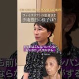 【切開/フェイスリフト】手術翌日の様子は？（60代女性）