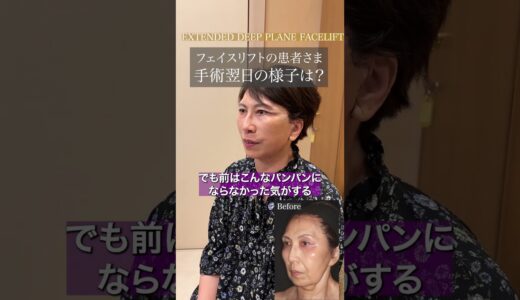 【切開/フェイスリフト】手術翌日の様子は？（60代女性）