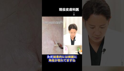 【超ｽｯｷﾘ!!】連続角栓除去を皮膚科医が解説 #shorts