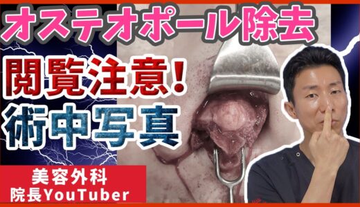 【鼻整形】オステオポールを除去する鼻の修正手術を解説【閲覧注意】